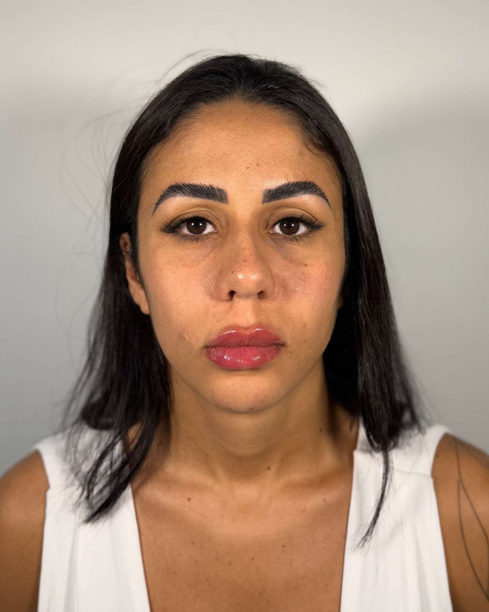 Retrato de frente da mesma paciente, depois do preenchimento labial.