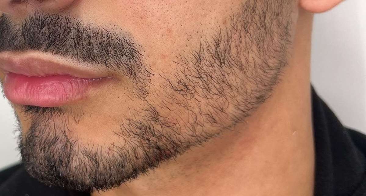 Perfil masculino com barba, depois.