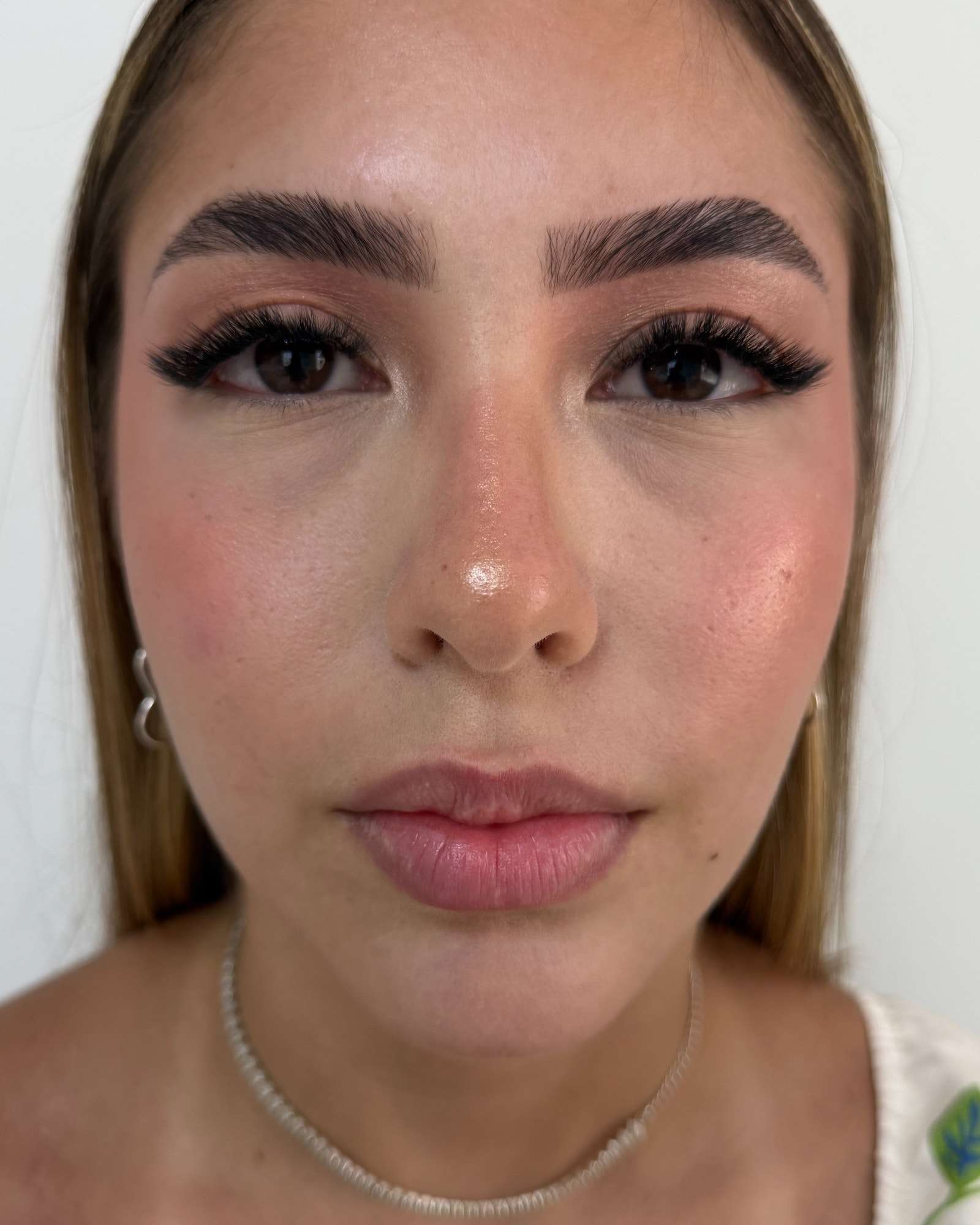 Retrato de frente de uma paciente, de perto, antes do preenchimento labial.
