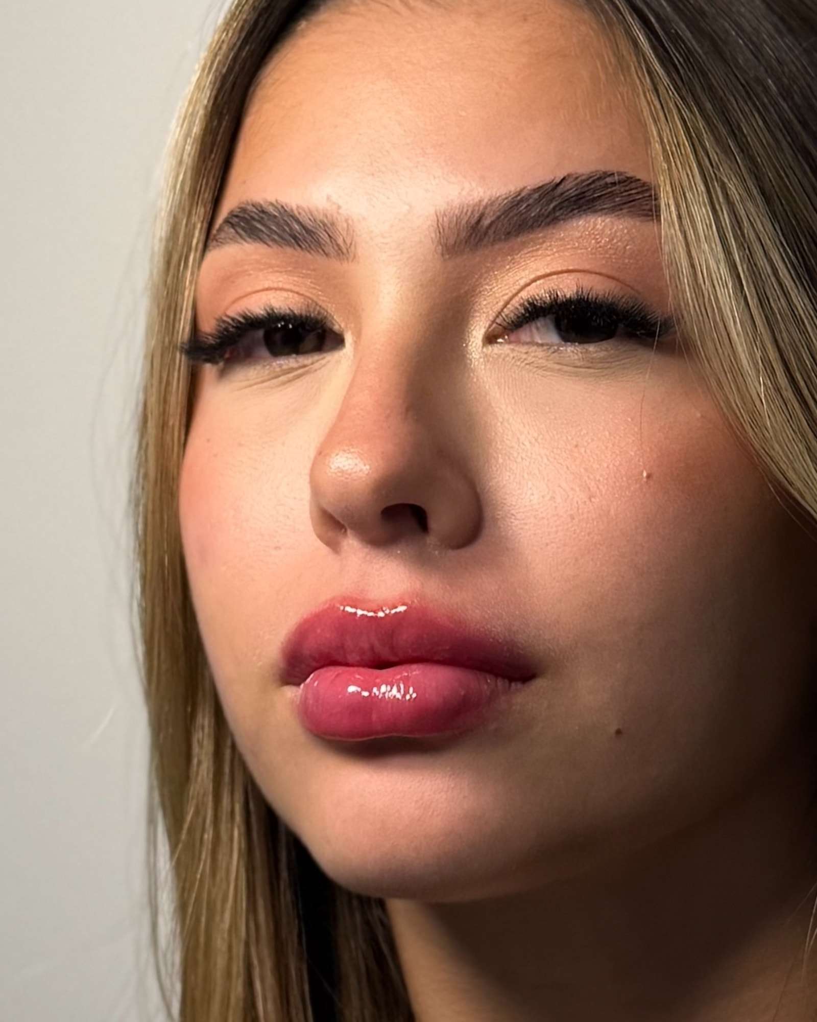 A mesma paciente com o rosto levemente virado, depois do preenchimento labial.